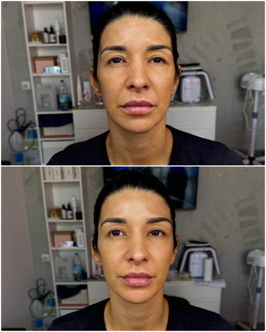 Formação da tecnologia HIFU MPT e LIPOSONIX